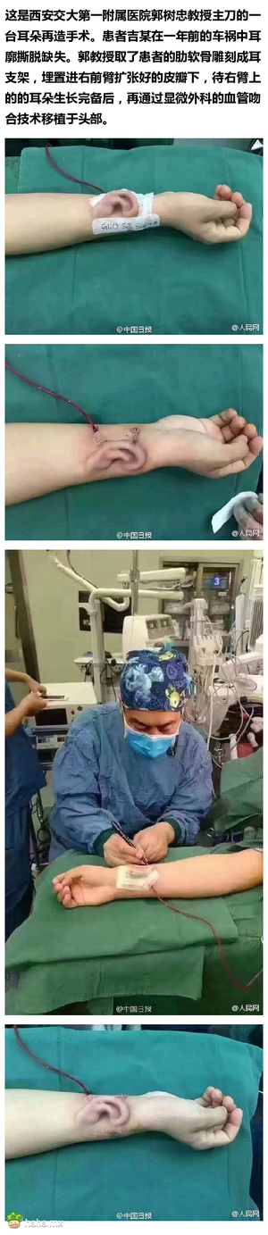 这不是科幻片！外形医生用肋骨再造耳朵！