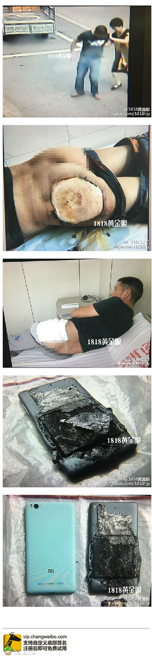 大伯臀部大面积烧伤 疑是小米手机起火